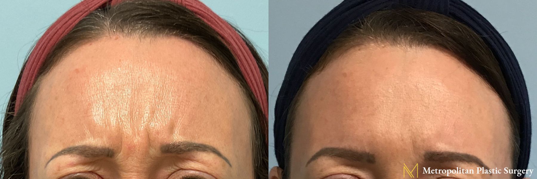 Botox performed by Dr. Julia Spears