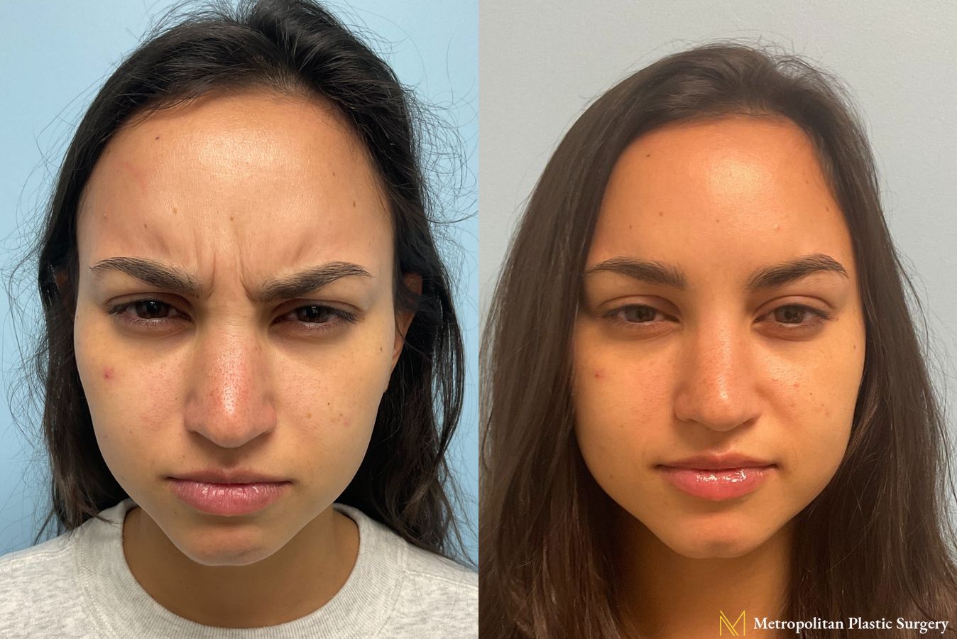 Before & after Botox Cosmetic application photos. - Angle 2