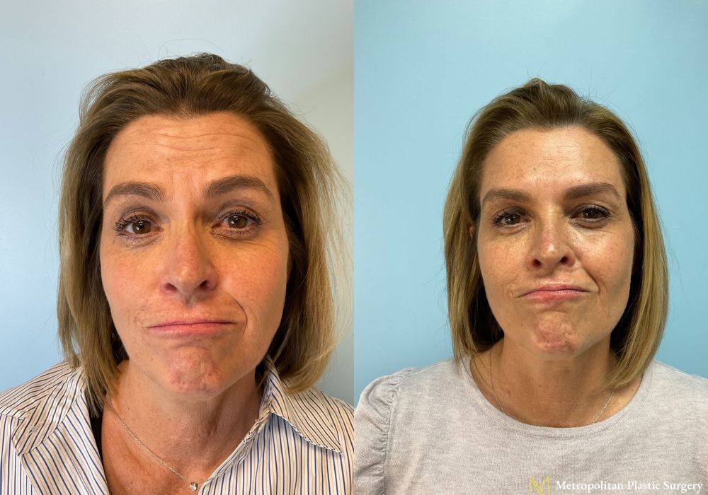 Before and after BOTOX® Cosmetic case 23812