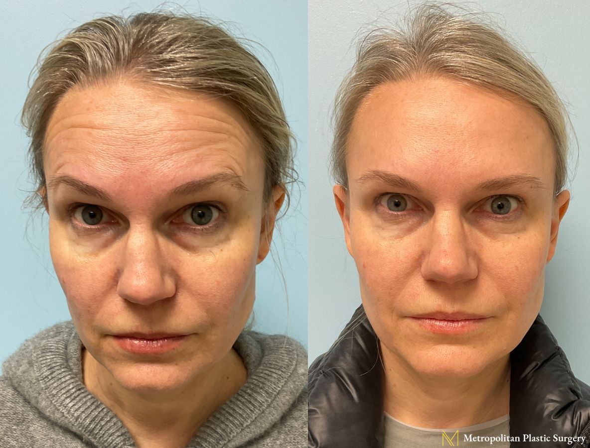 Botox injections to Forehead, Upper Lip, Frown Lines , and Crows Feet performed by Dr. Julia Spears at Metropolitan Plastic Surgery