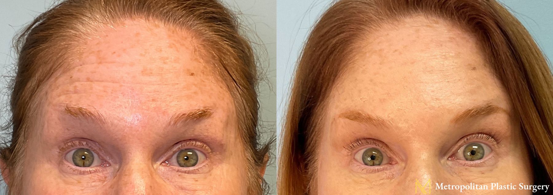 Before and after BOTOX® Cosmetic case 23986