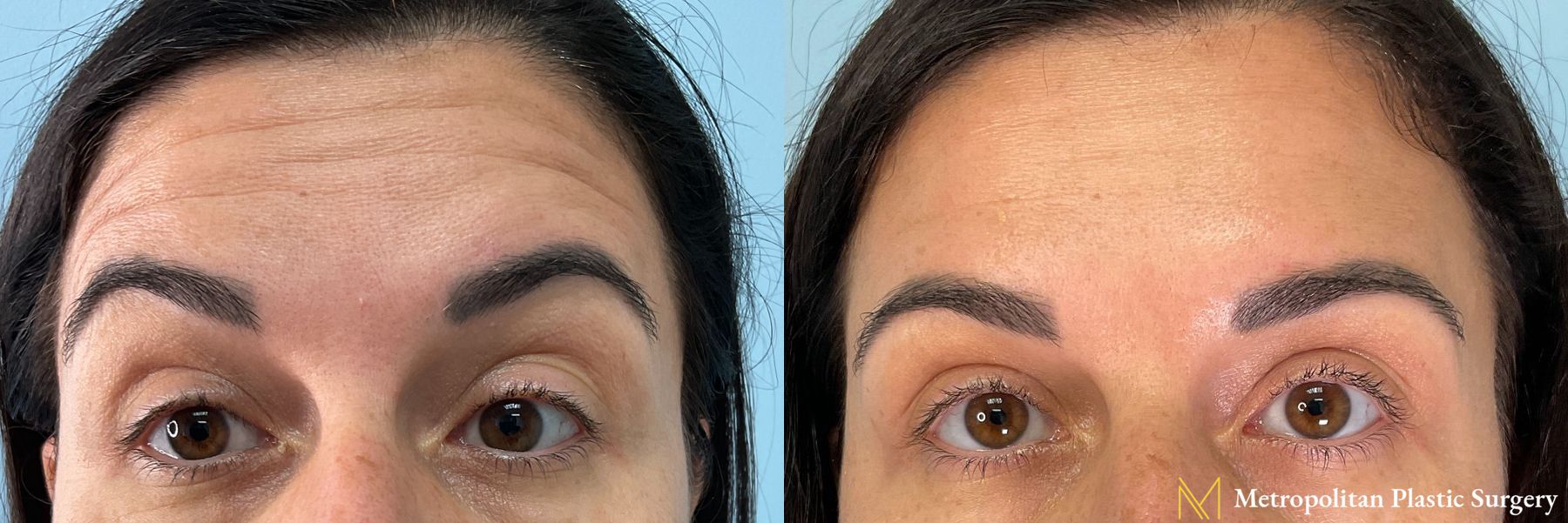 Botox performed by Dr. Julia Spears