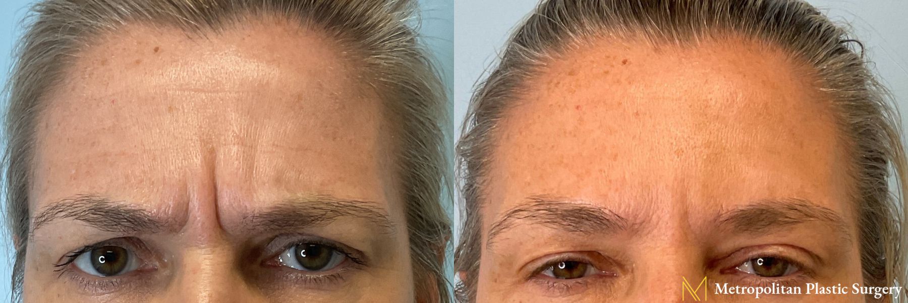Botox performed by Dr. Julia Spears - Angle 2