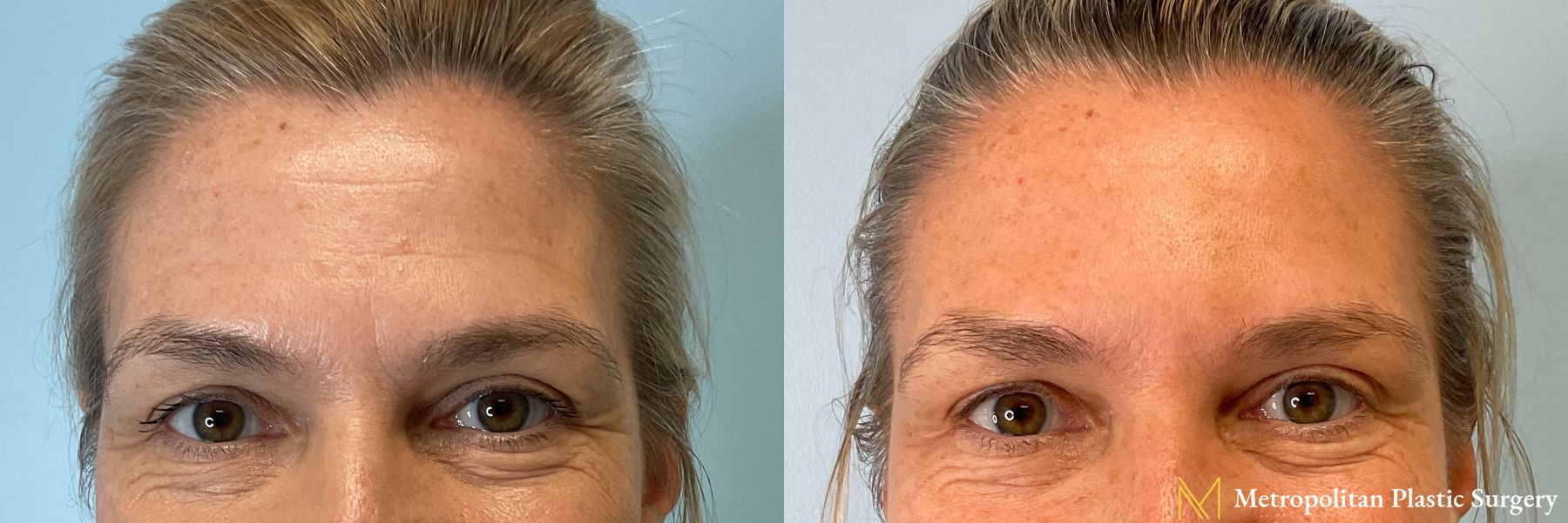 Botox performed by Dr. Julia Spears - Angle 3