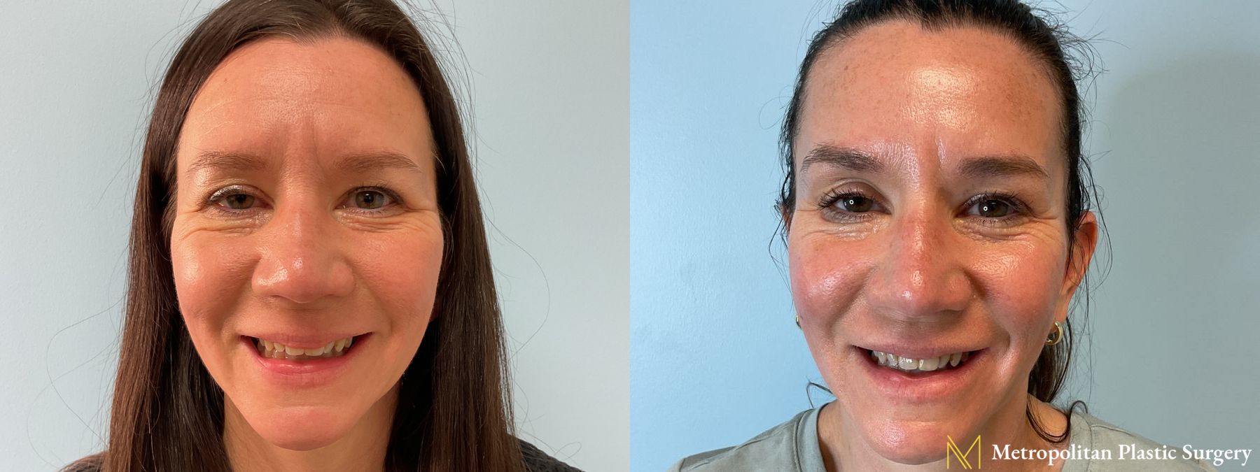 Botox performed by Dr. Julia Spears - Angle 3