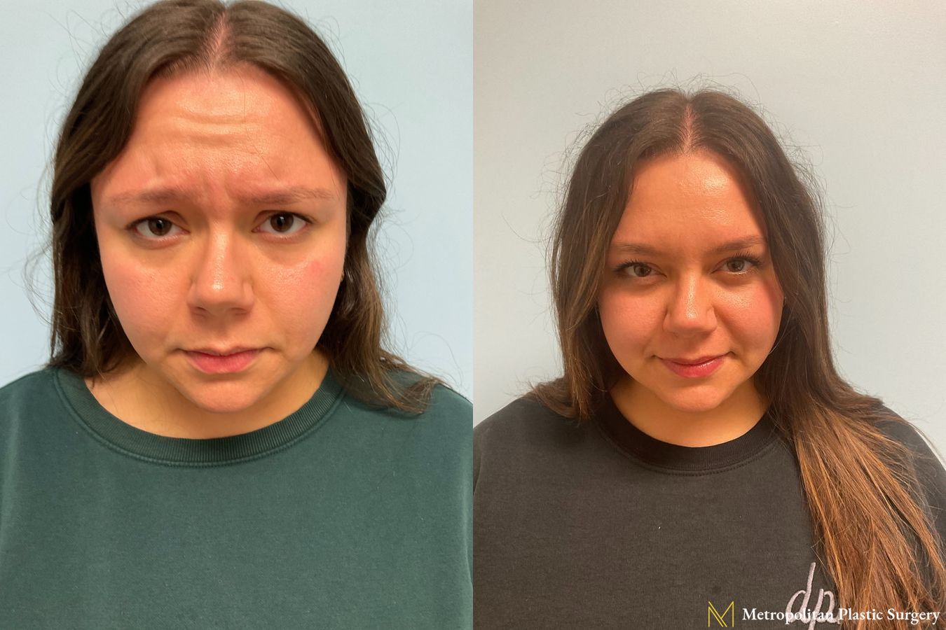Before & after Botox Cosmetic application photos. - Angle 2