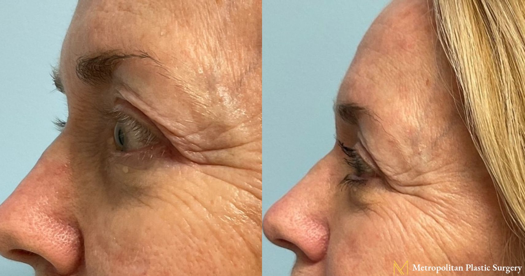 No more tired eyes with eye lid surgery from Julia Spears MD - Angle 3