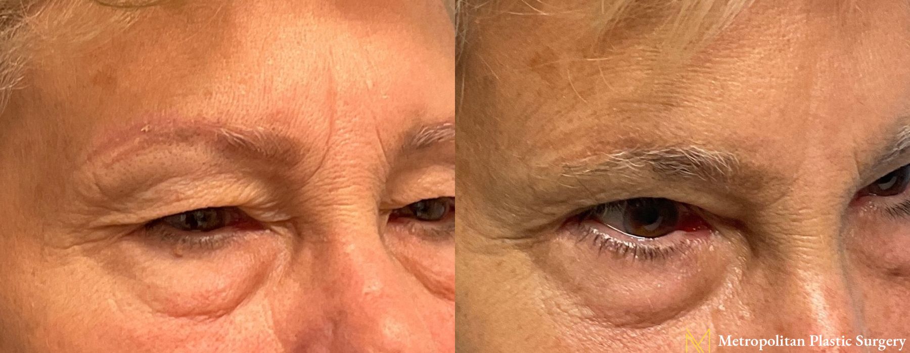 Blepharoplasty - Thumbnail 3