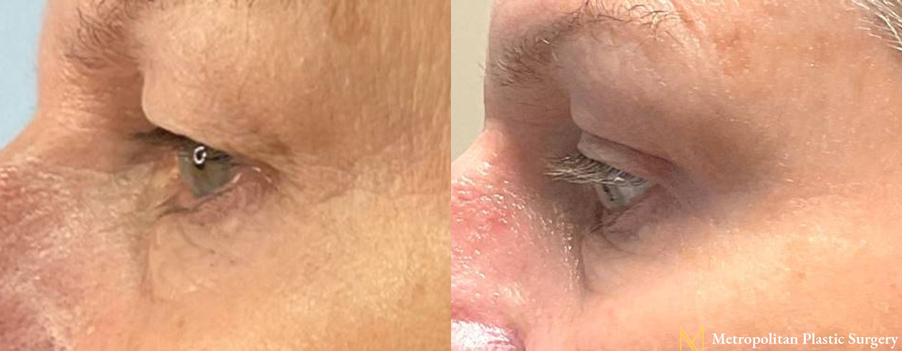 Blepharoplasty - Case 119