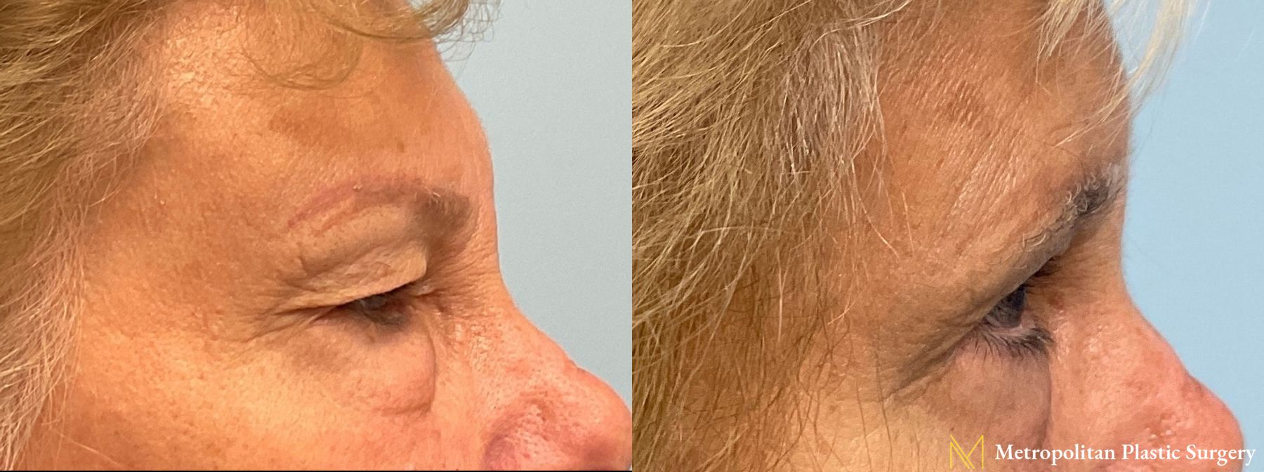 Before and after Blepharoplasty case 8001 - Angle 2