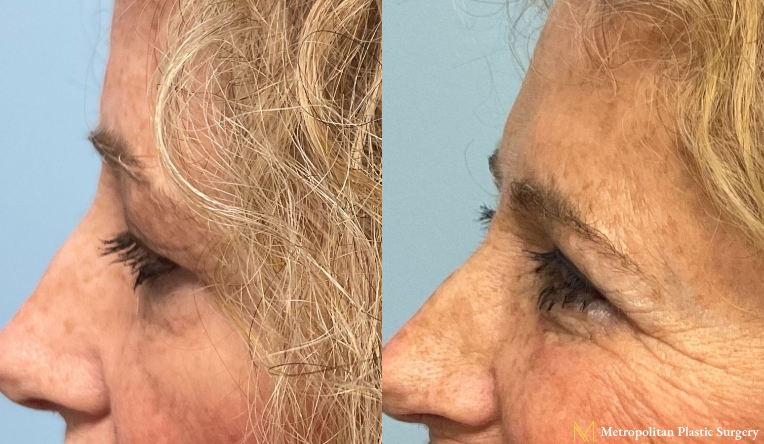 Julia Spears MD Eye Lid Surgery (Blepharoplasty) Before and After - Angle 4