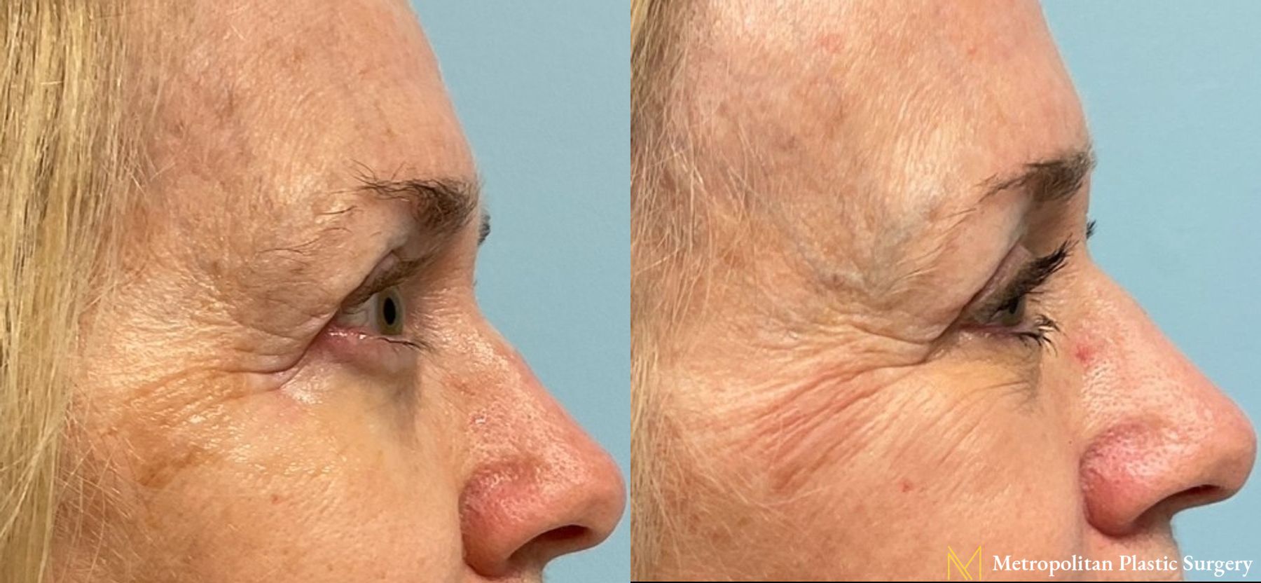 No more tired eyes with eye lid surgery from Julia Spears MD - Angle 2