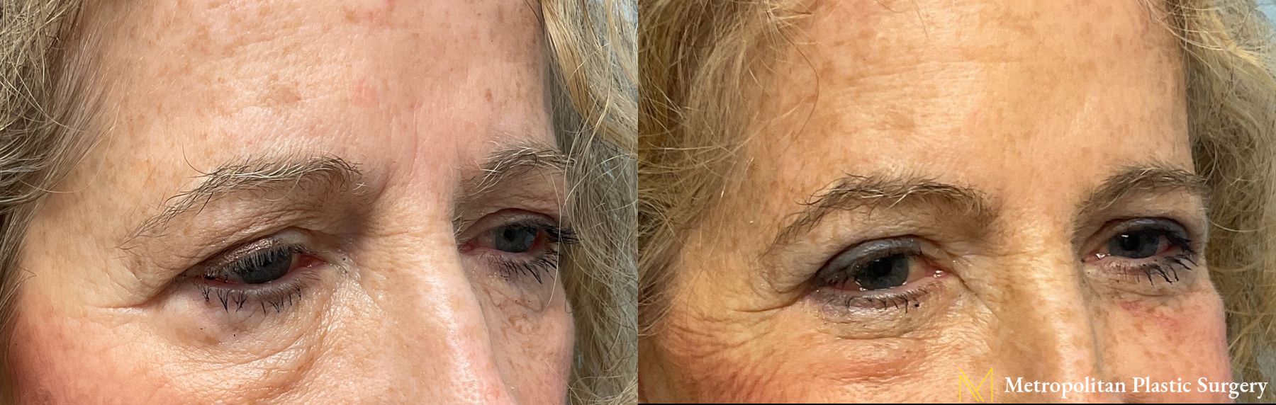 Julia Spears MD Eye Lid Surgery (Blepharoplasty) Before and After - Angle 3