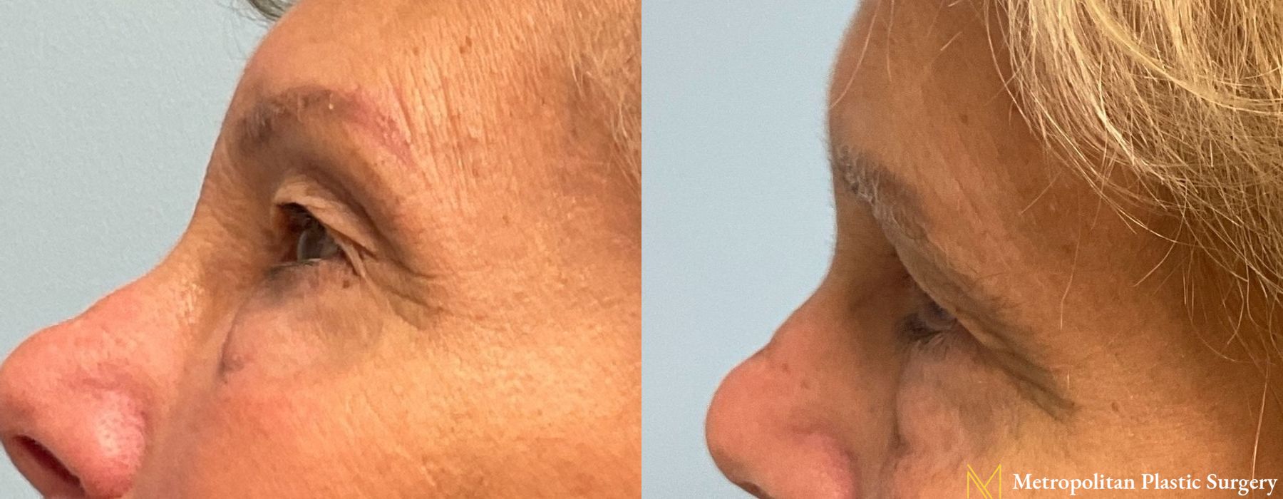 Blepharoplasty - Thumbnail 5