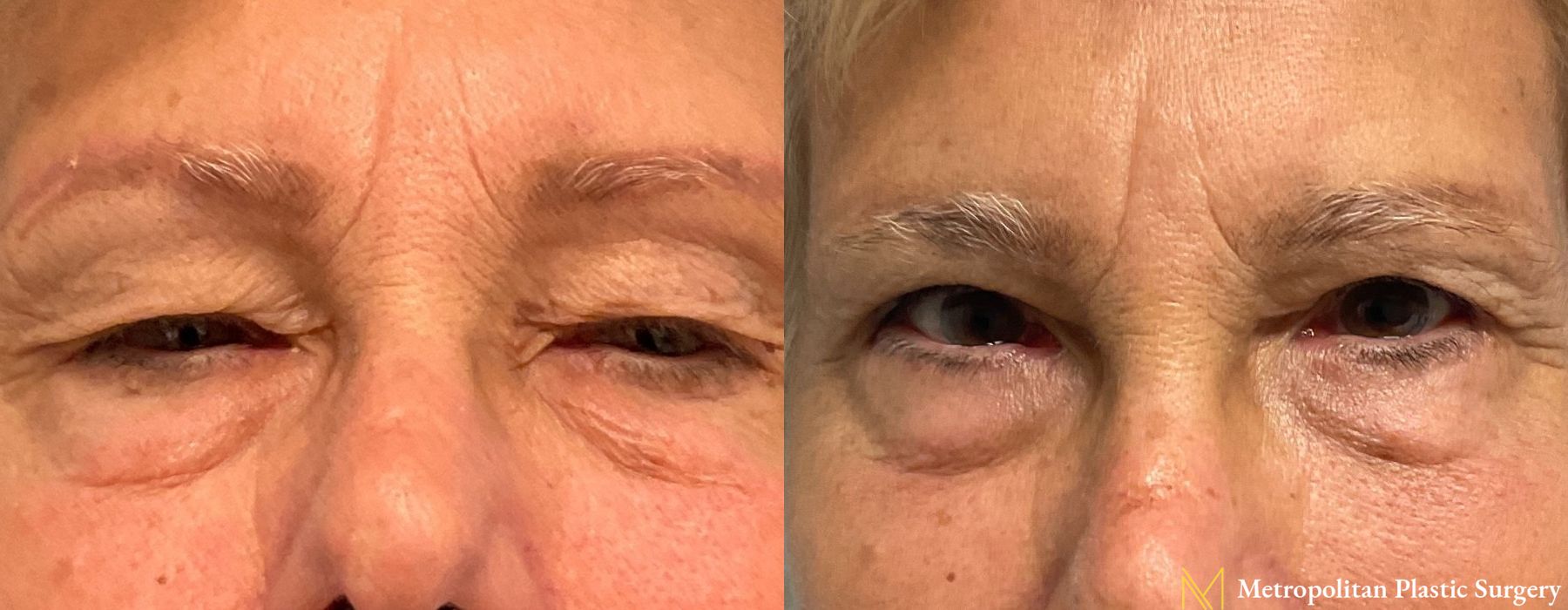 Blepharoplasty - Case 278