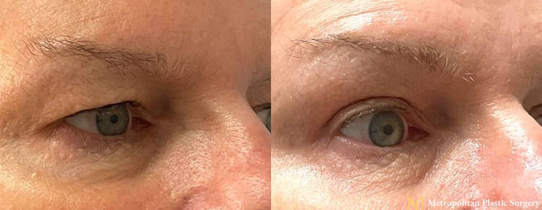 Blepharoplasty - Thumbnail 2