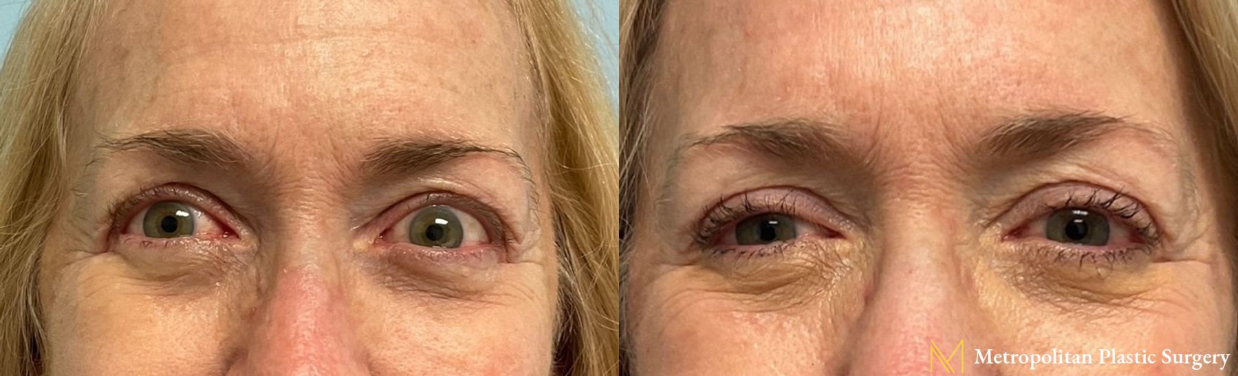 No more tired eyes with eye lid surgery from Julia Spears MD