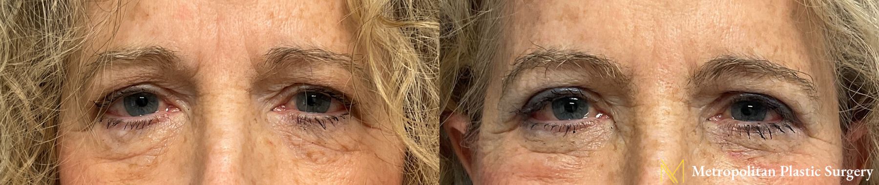 Julia Spears MD Eye Lid Surgery (Blepharoplasty) Before and After