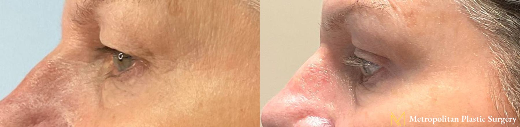 Before and after Blepharoplasty case 10054 - Angle 2