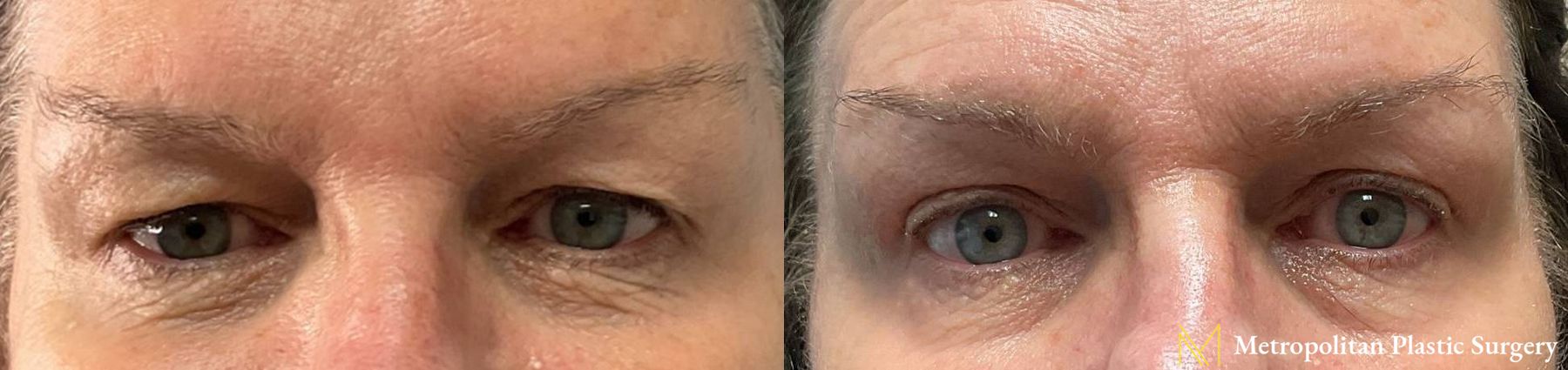 Before and after Blepharoplasty case 10054