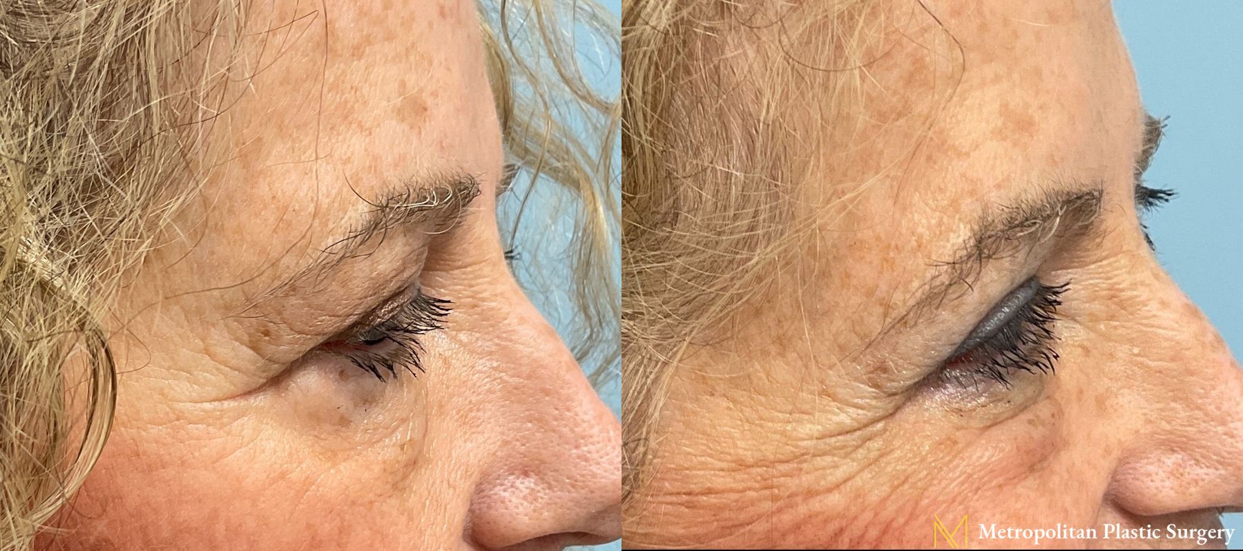 Julia Spears MD Eye Lid Surgery (Blepharoplasty) Before and After - Angle 2