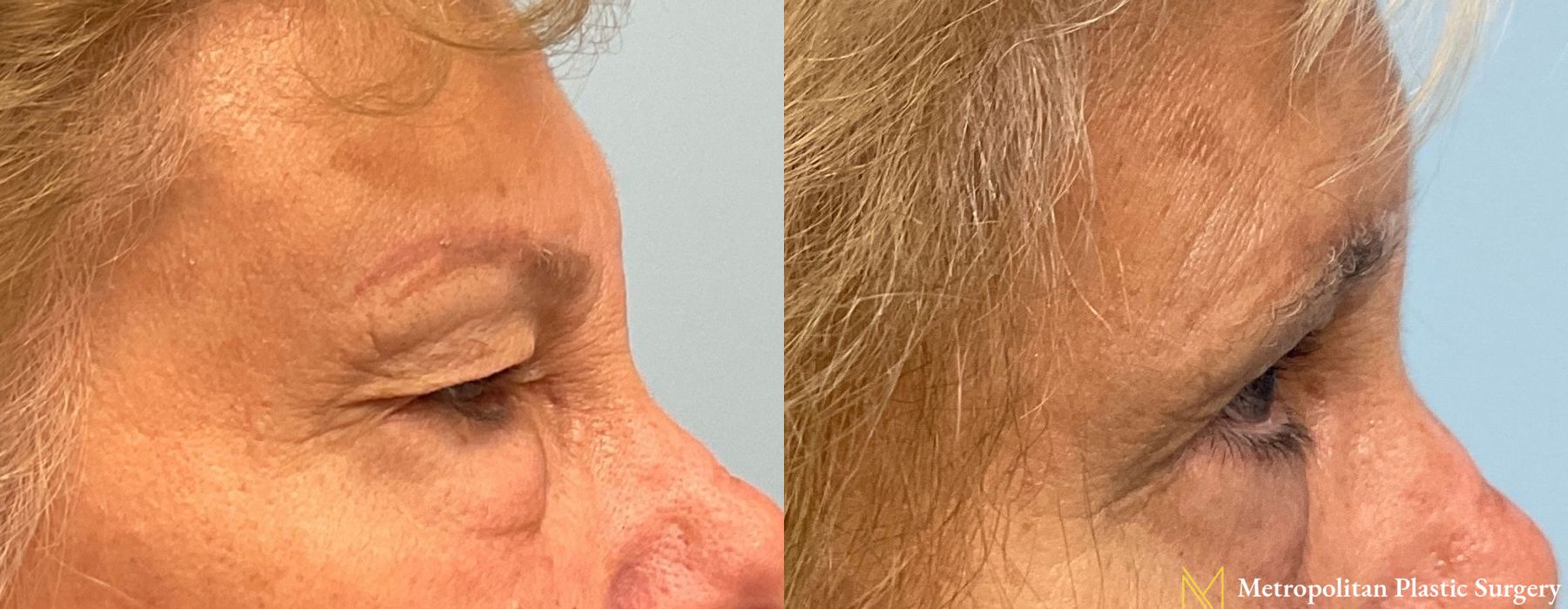 Blepharoplasty - Thumbnail 2