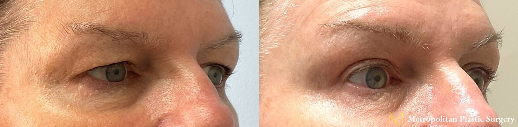 Before and after Blepharoplasty case 10054 - Angle 3
