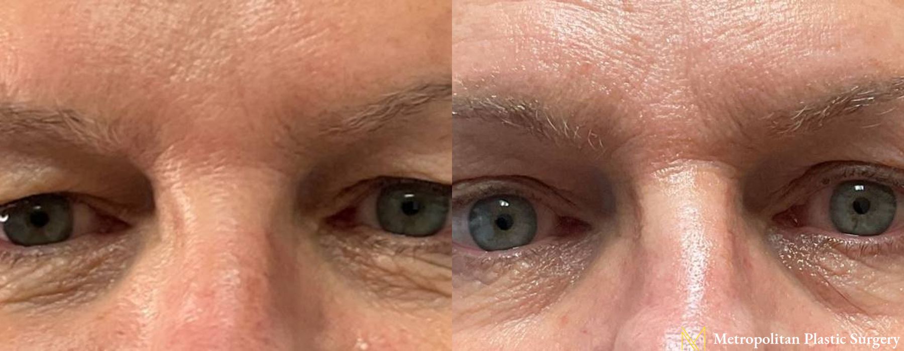 Blepharoplasty - Thumbnail 3