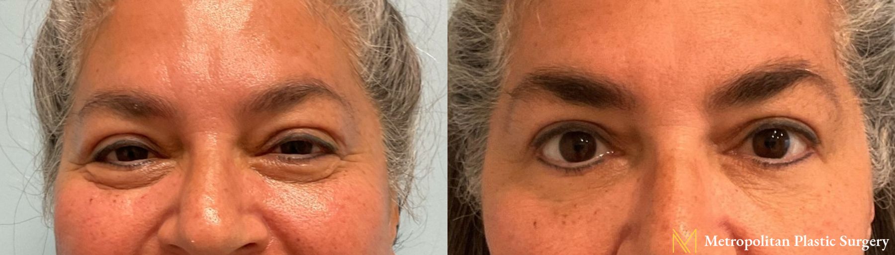 Julia Spears MD Eye Lid Surgery (Blepharoplasty) Before and After