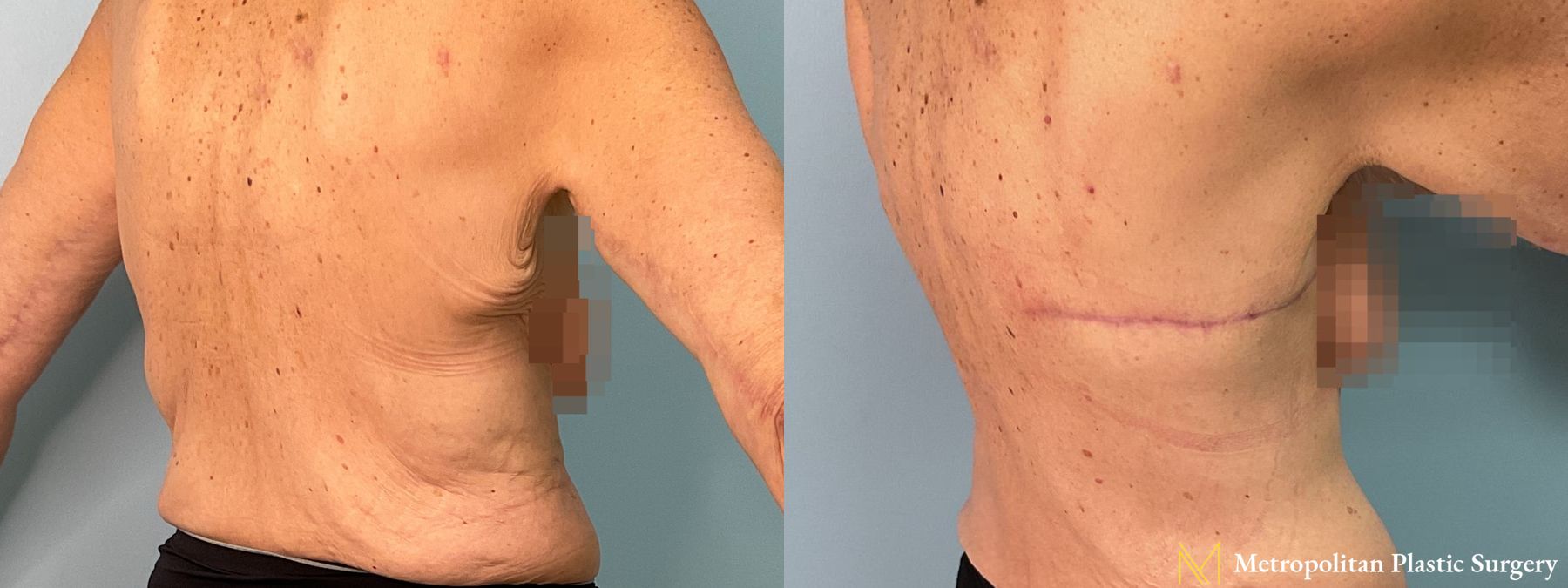 Before and after Bra Line Lift case 41373 - Angle 2