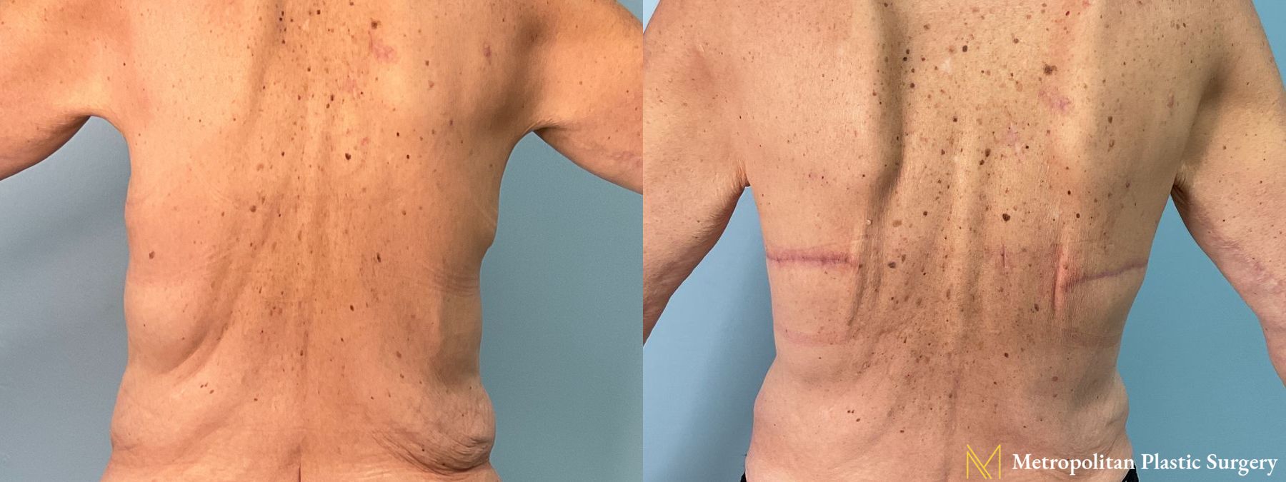 Before and after Bra Line Lift case 41373