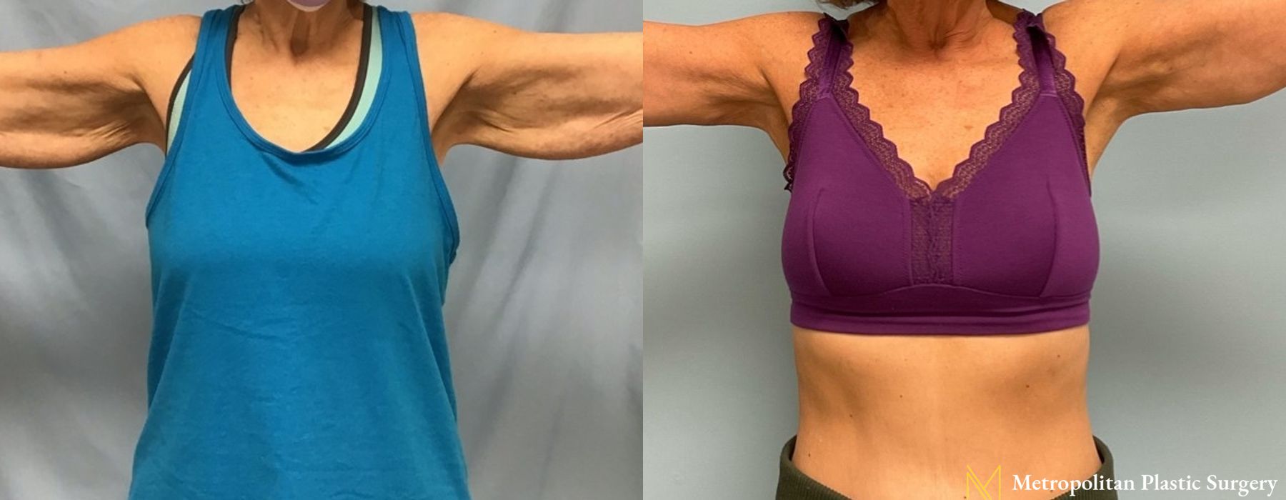 Brachioplasty - Thumbnail 2