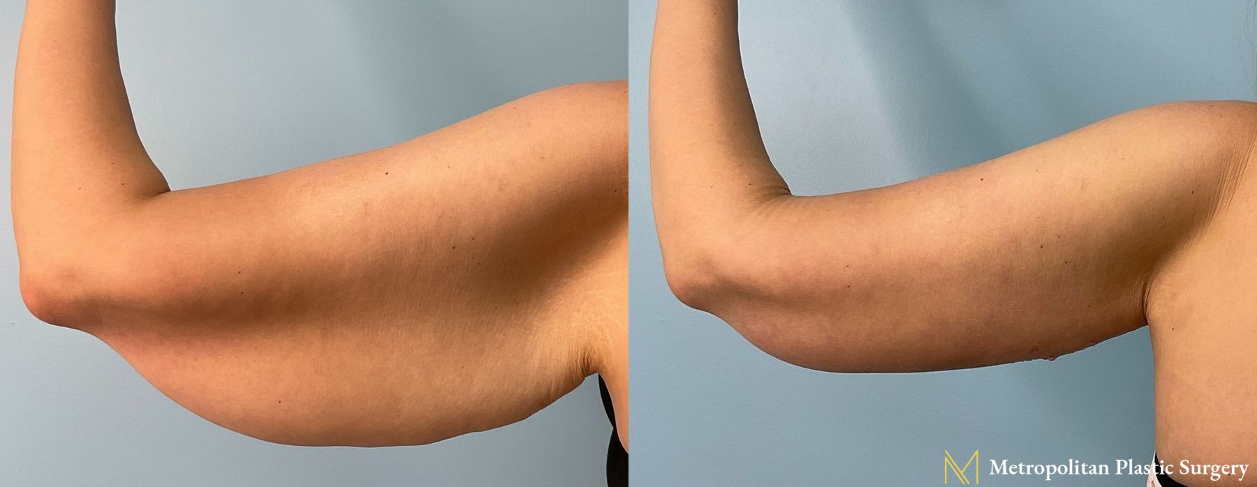 Before and after Arm Lift case 8057 - Angle 2