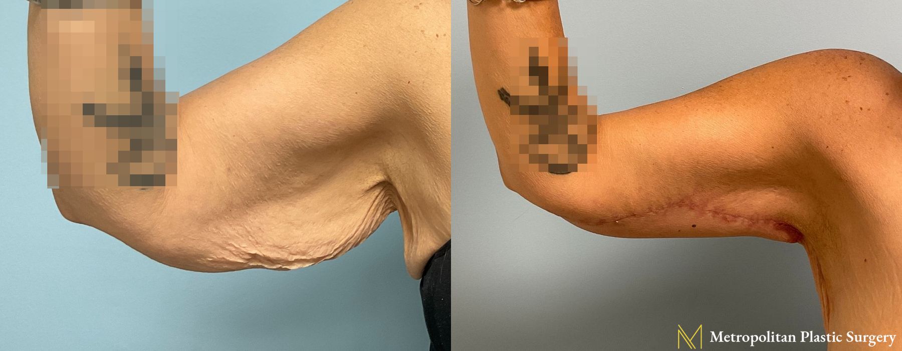 Brachioplasty - Thumbnail 2