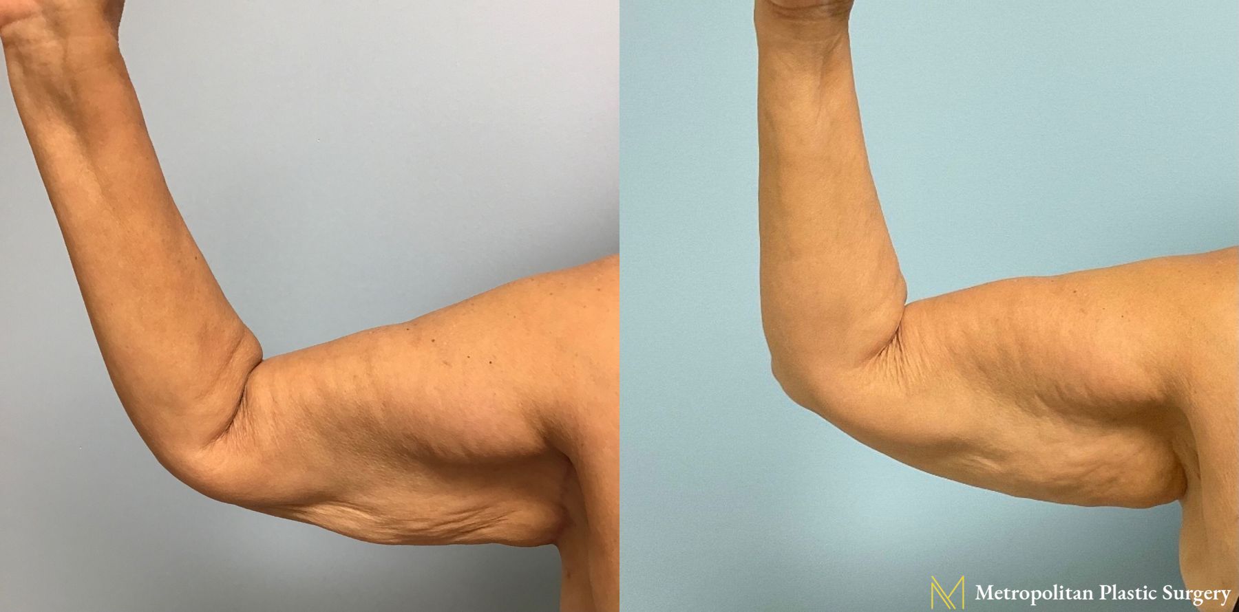 Julia Spears MD Arm Lift Surgery (Brachioplasty) Before and After - Angle 4