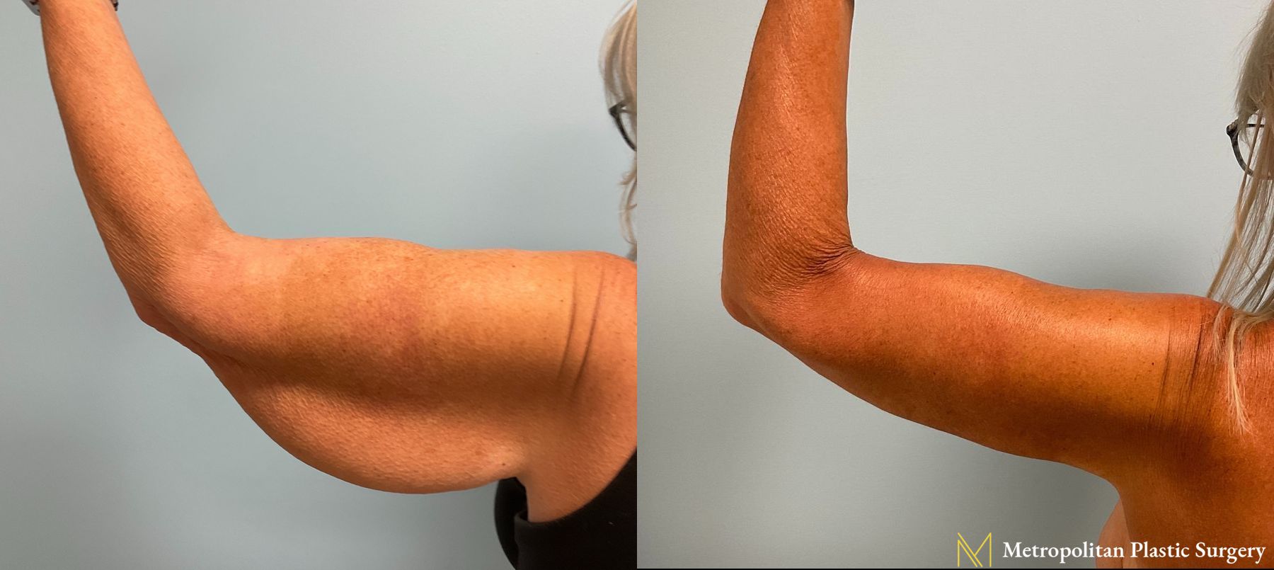 Before and after Arm Lift case 8004 - Angle 3