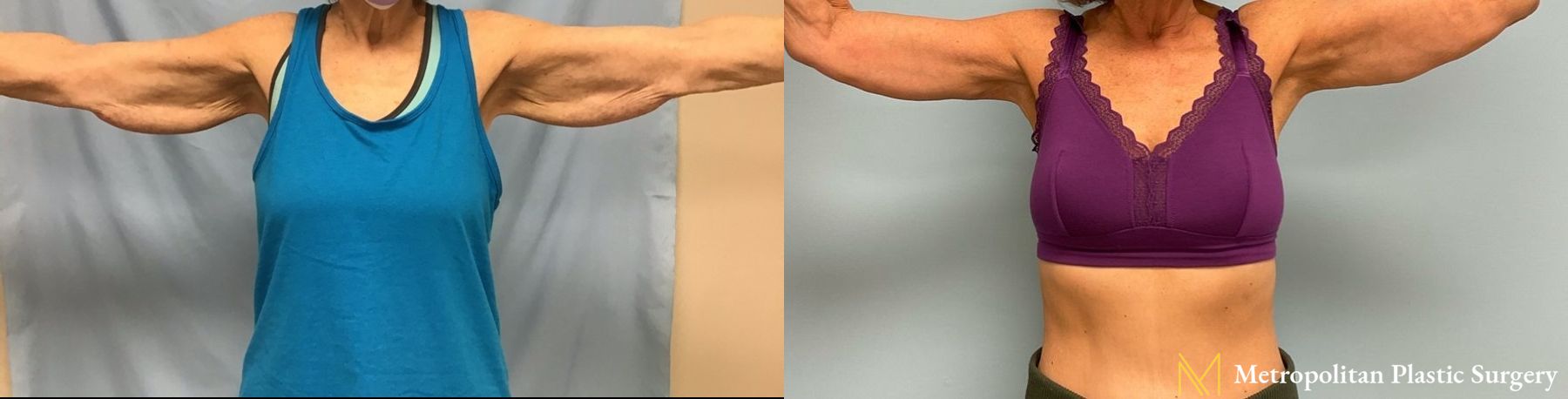 Julia Spears MD Arm Lift Surgery (Brachioplasty) Before and After