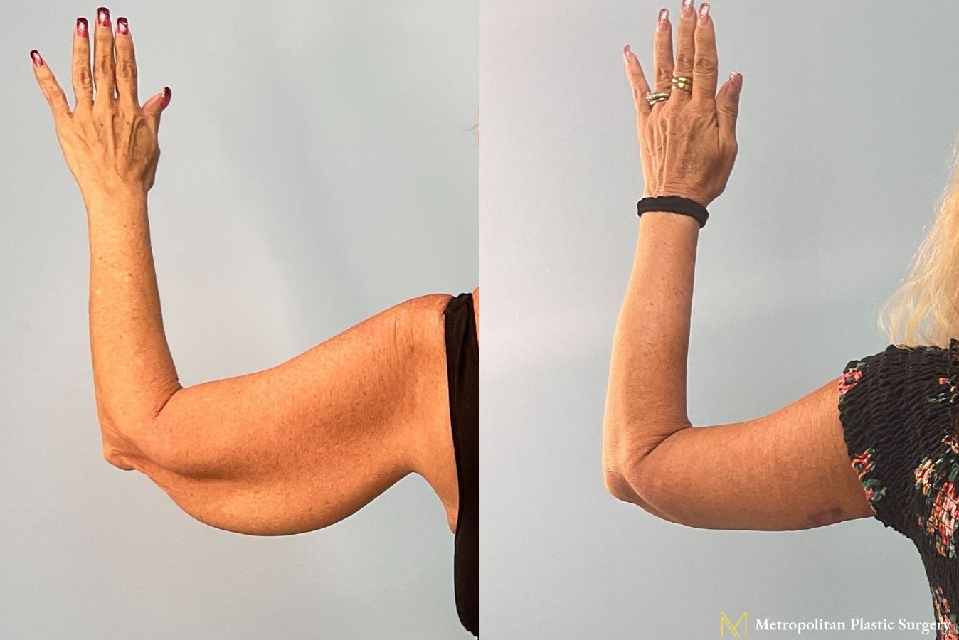 Before and after Brachioplasty photos - Angle 3