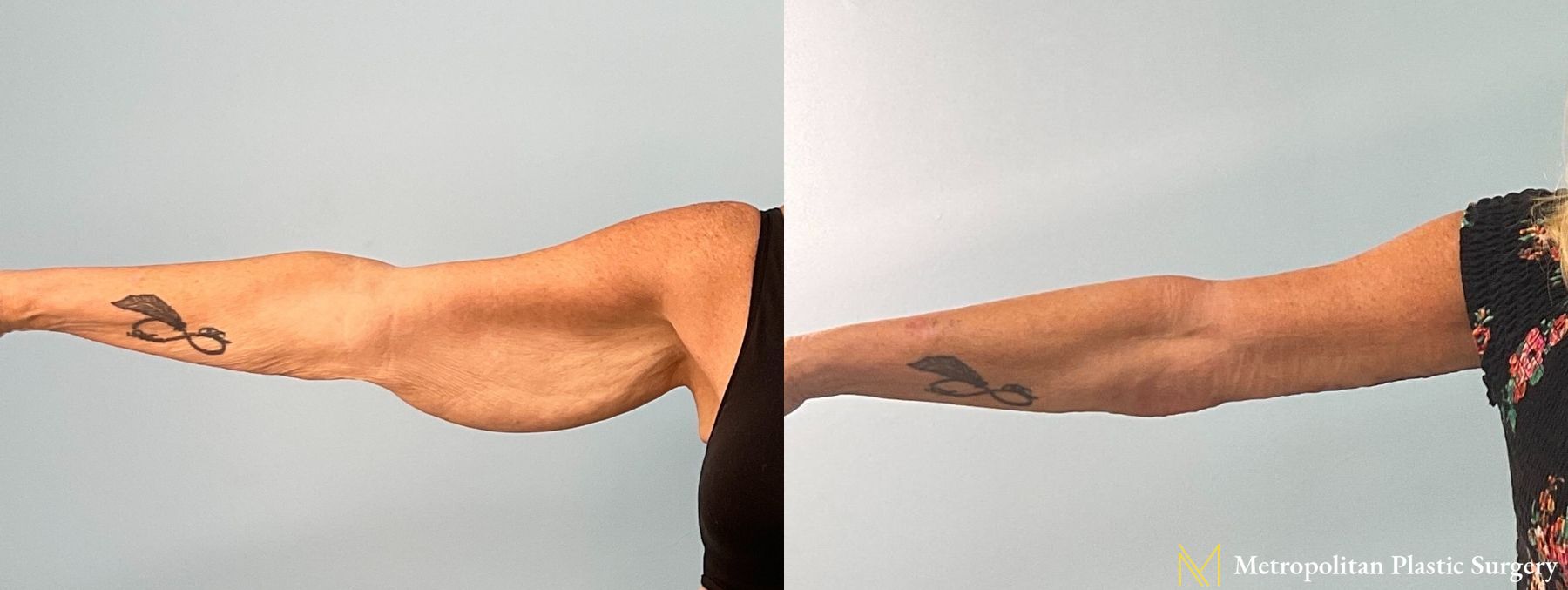 Before and after Brachioplasty photos