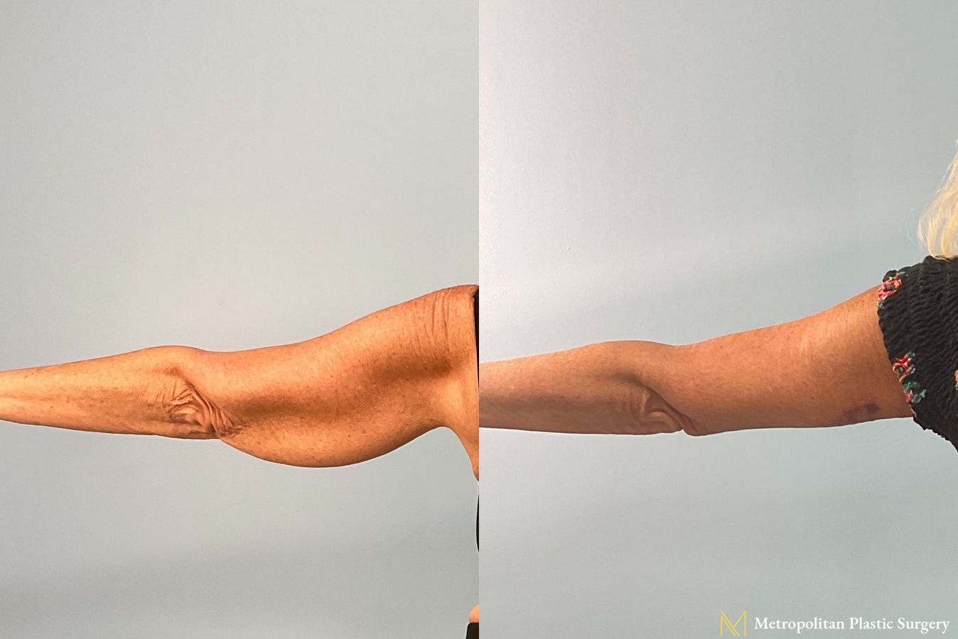 Before and after Brachioplasty photos - Angle 5