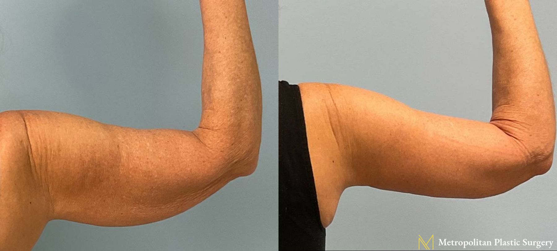 Dermal Fillers Before and After Smooth Skin Without Lines or Wrinkles - Angle 2