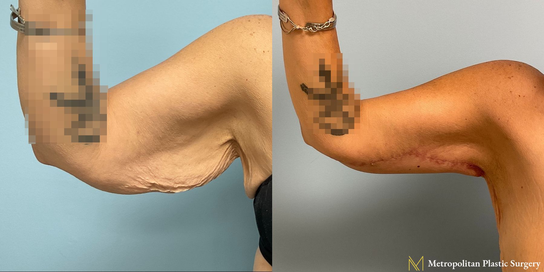 Before and after Arm Lift case 8030 - Angle 2