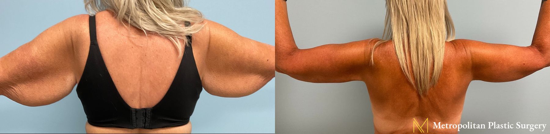 Before and after Arm Lift case 8004 - Angle 2