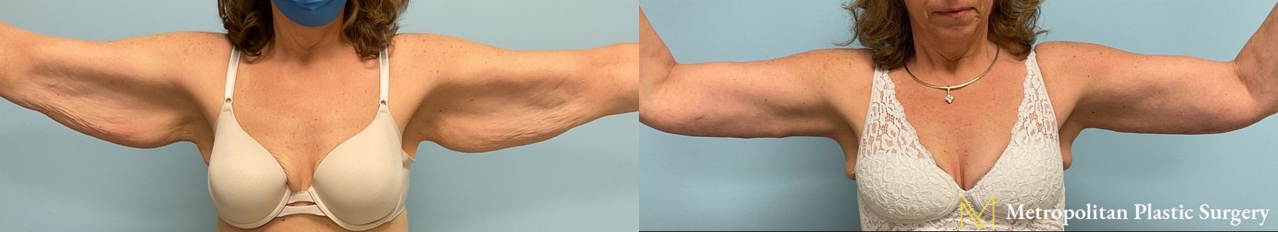 Remove Excess Arm skin and fat with Brachioplasty from Julia Spears MD