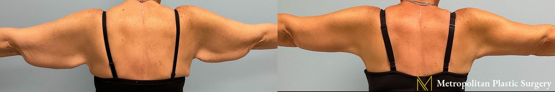 Before and after Arm Lift case 8030 - Angle 4