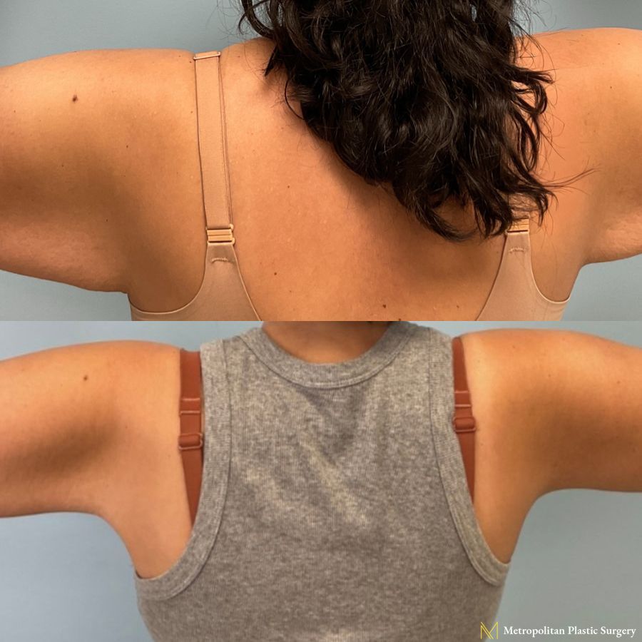 Brachioplasty - Case 189