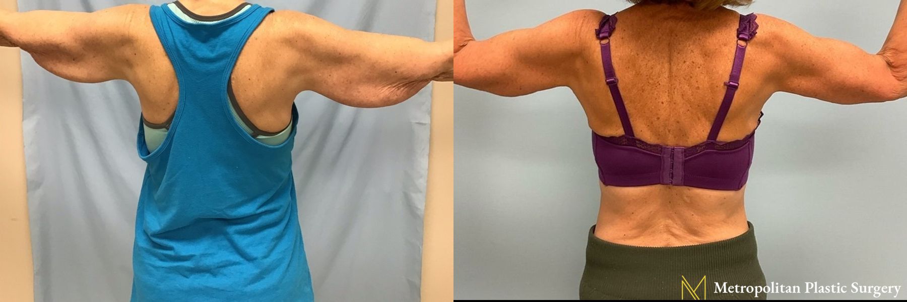 Julia Spears MD Arm Lift Surgery (Brachioplasty) Before and After - Angle 2