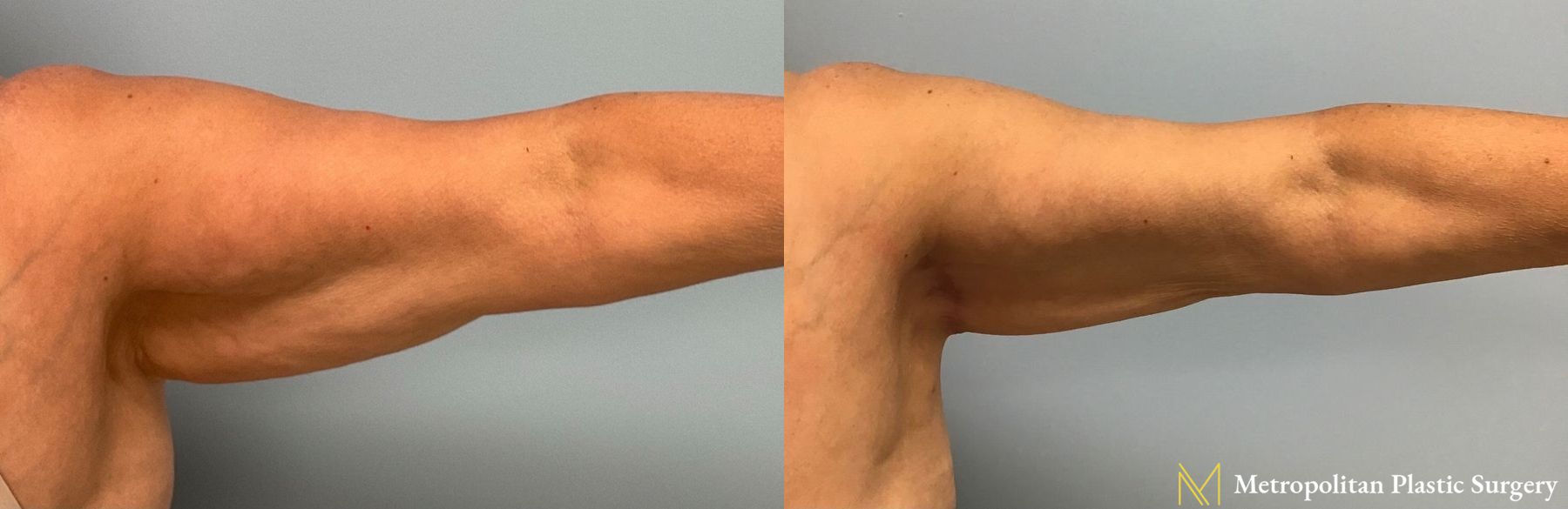 Julia Spears MD Arm Lift Surgery (Brachioplasty) Before and After