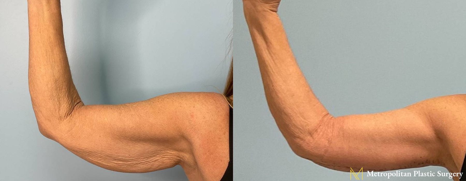 Before and after Liposuction case 12304