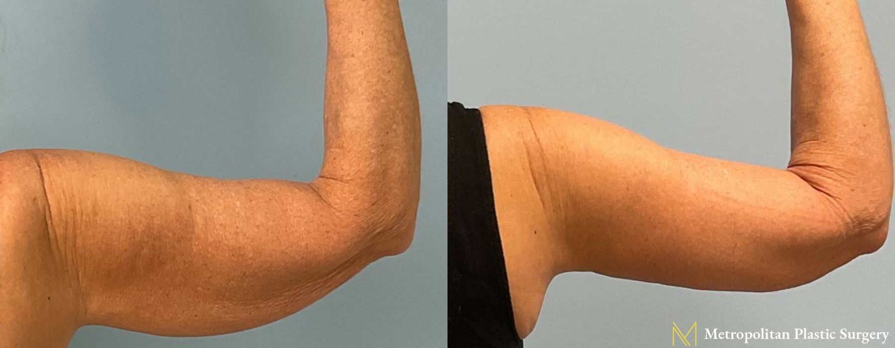 Before and after Liposuction case 12304 - Angle 2